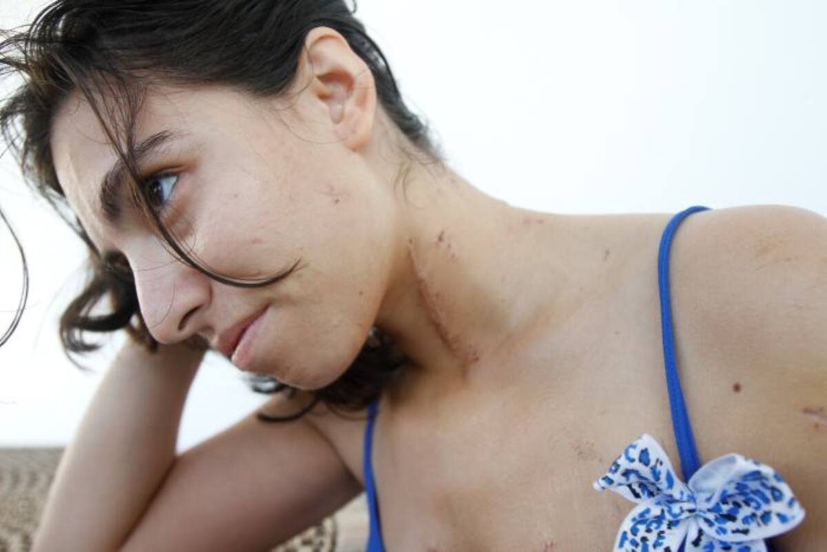 A Jessica la operaron 3 veces por las lesiones en la yugular, el pulmón izquierdo y el pecho. Aún no puede conciliar el sueño por las pesadillas.