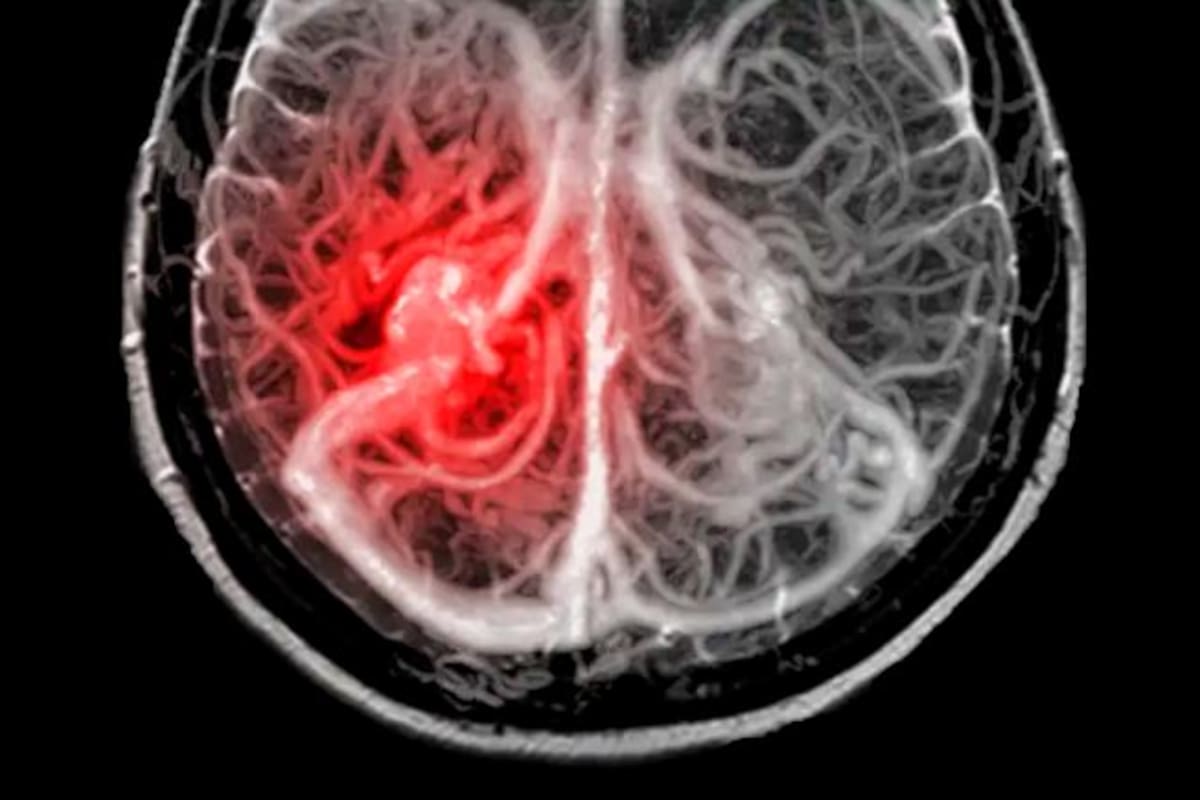 Un caso único en el mundo: niño se cura de un tumor cerebral mortal