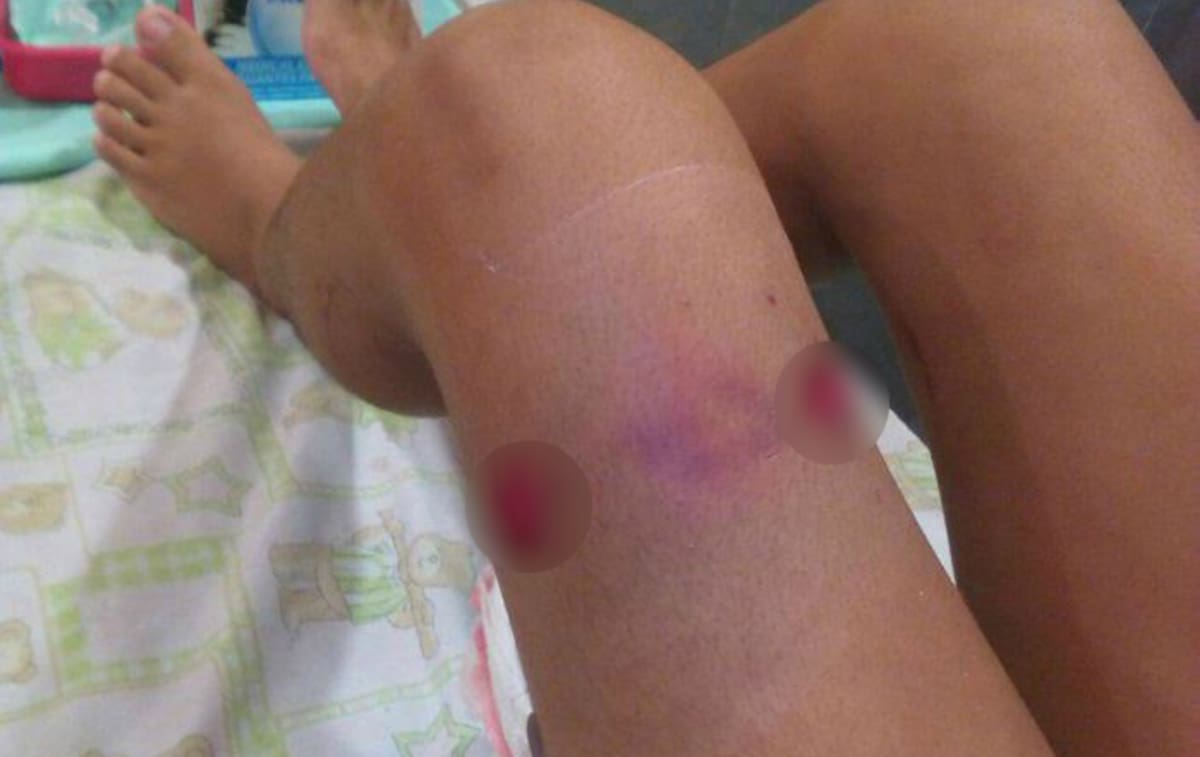 El proyectil perforó la pierna izquierda de la niña, quien por fortuna se recupera satisfactoriamente. Cortesía.