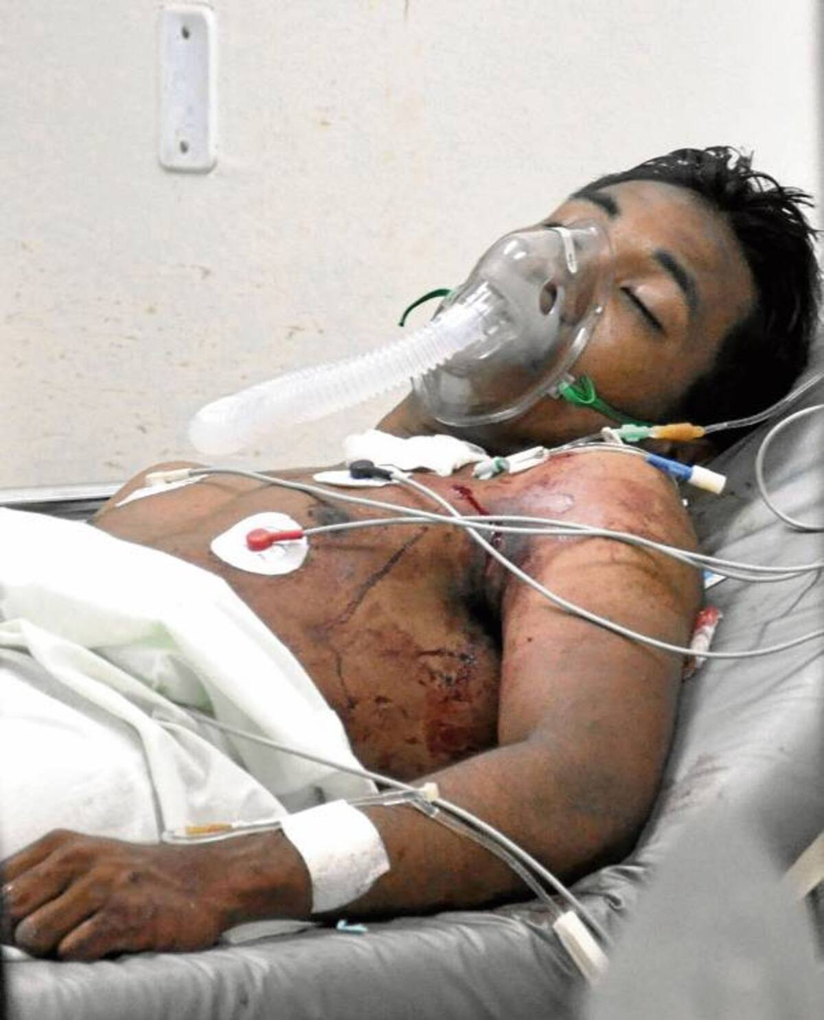 Alias “El Calé” resultó herido en los mismos hechos en que murió Bairon Alexander Gutiérrez Contreras.