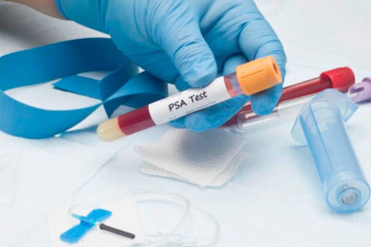 Cáncer de próstata, el más letal y silencioso, y el menos prevenible