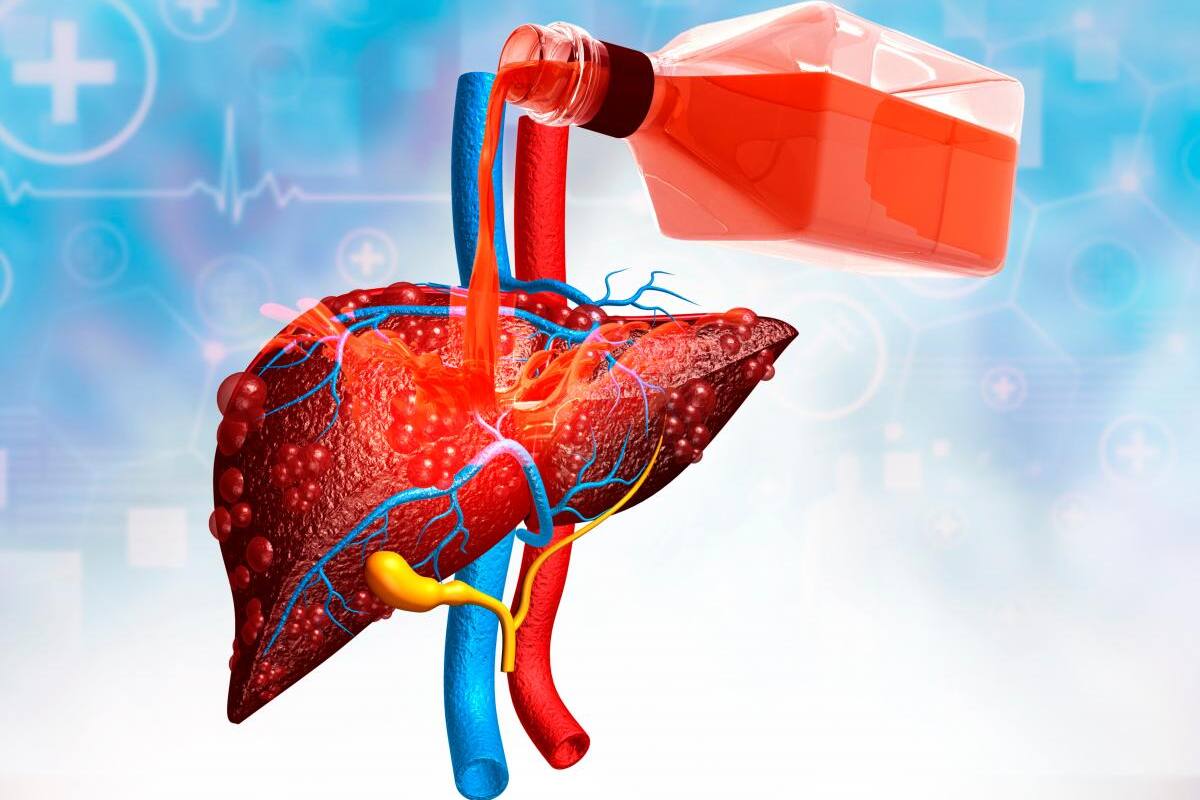 Cirrosis hepática, una enfermedad silenciosa y mortal