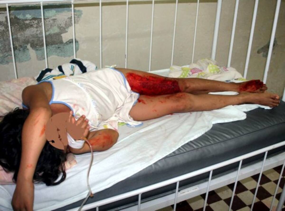 Una niña de 6 años de edad, oriunda de Turbaco, Bolívar, resultó con quemadoras de segundo grado al caerle encima un sartén con aceite hirviendo.