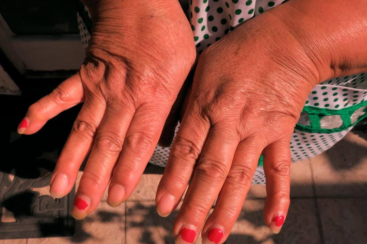 ¡No tiene cura! Mil millones de personas sufrirán osteoartritis en 2050