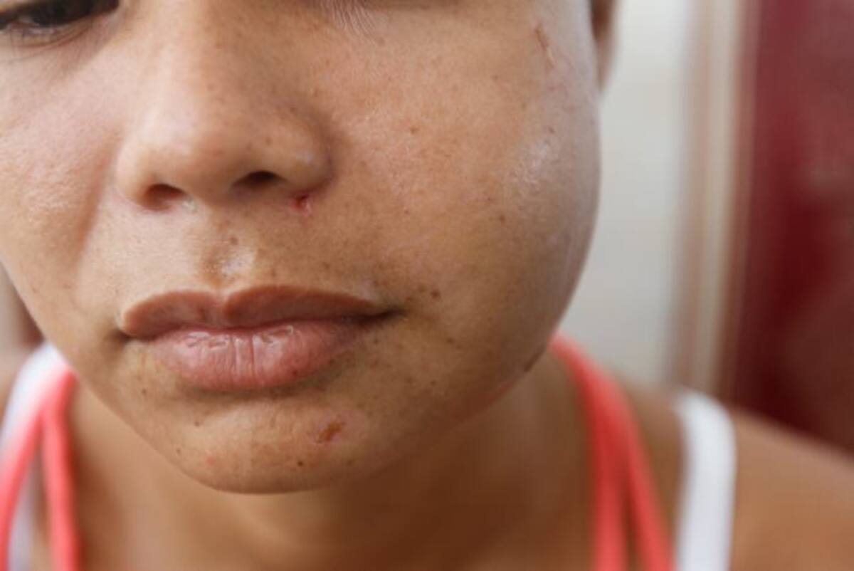 Así quedó el rostro de Yulieth Paola cuando fue agredida. Foto: Archivo