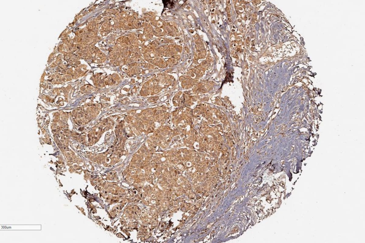 Identifican una nueva diana terapéutica contra el cáncer de mama