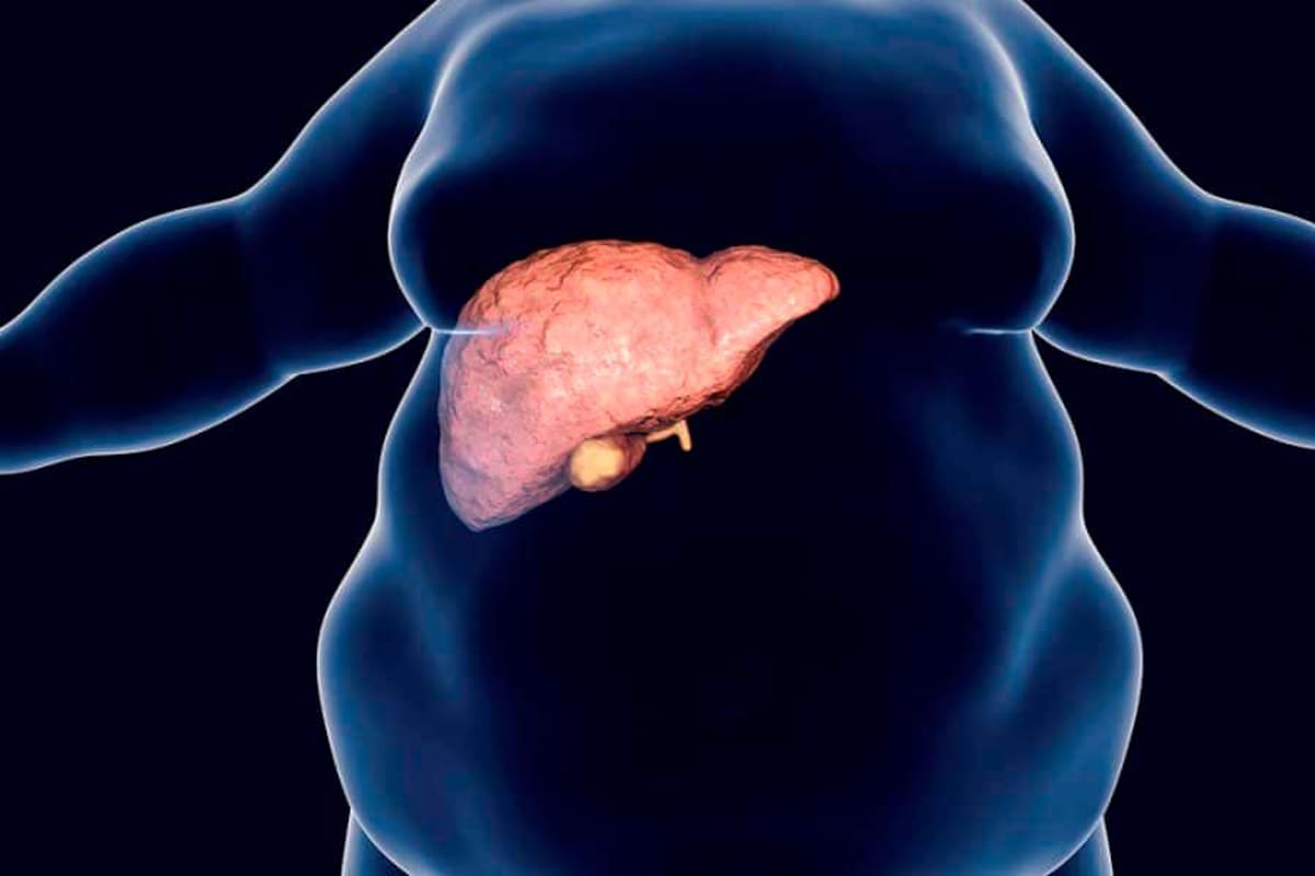 Esto es lo que puede hacer para prevenir el hígado graso