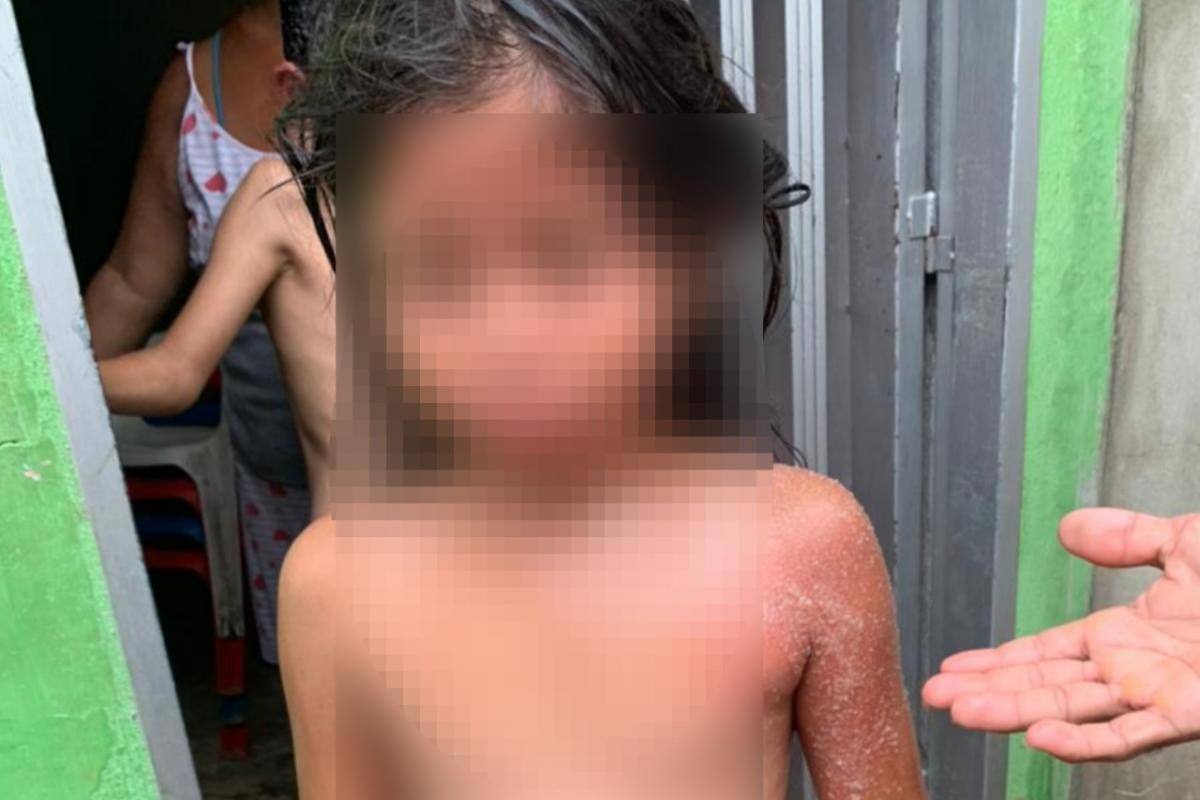 Dos niños habrían sido quemados con aceite por su propia madre en Sincelejo