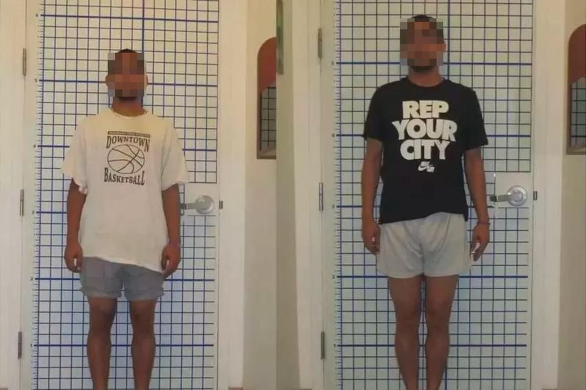 La peligrosa cirugía plástica con la que los hombres aumentan su estatura