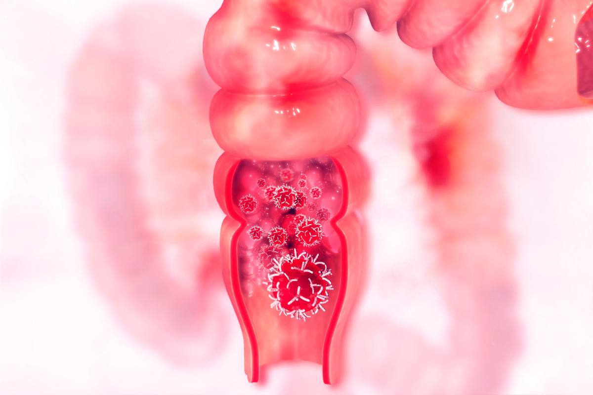 Día Mundial contra el Cáncer de Colon y Recto, ¿cómo detectarlo a tiempo?