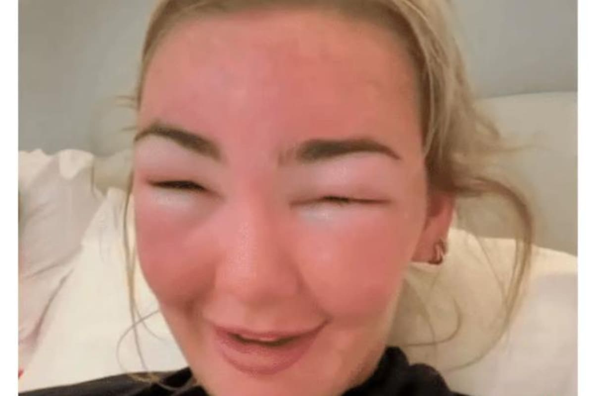 Cuide su piel en vacaciones: joven fue diagnosticada con envenenamiento solar