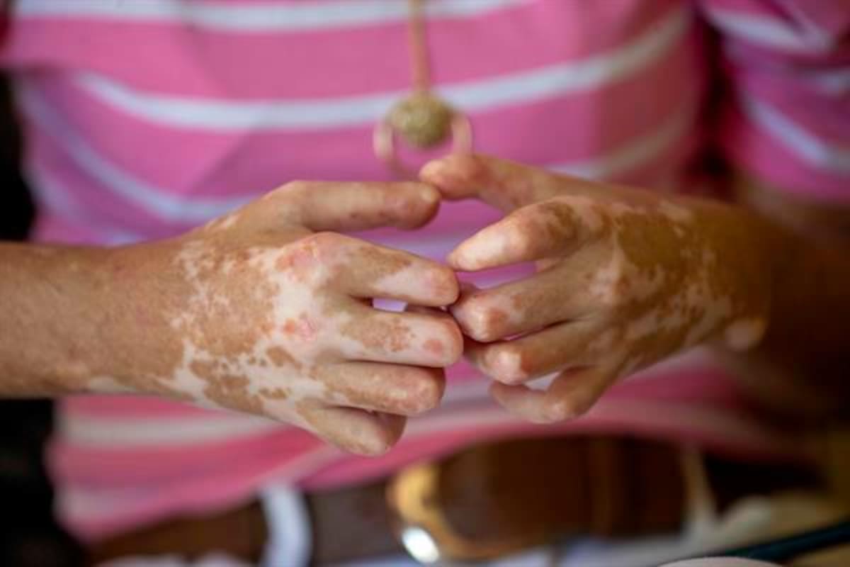 Día Mundial de la Esclerodermia, una enfermedad que necesita atención