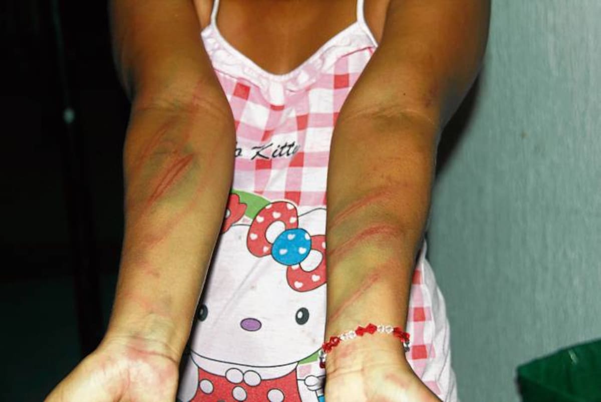 Los brazos de la joven, de 22 años, están magullados por el brutal ataque del qu