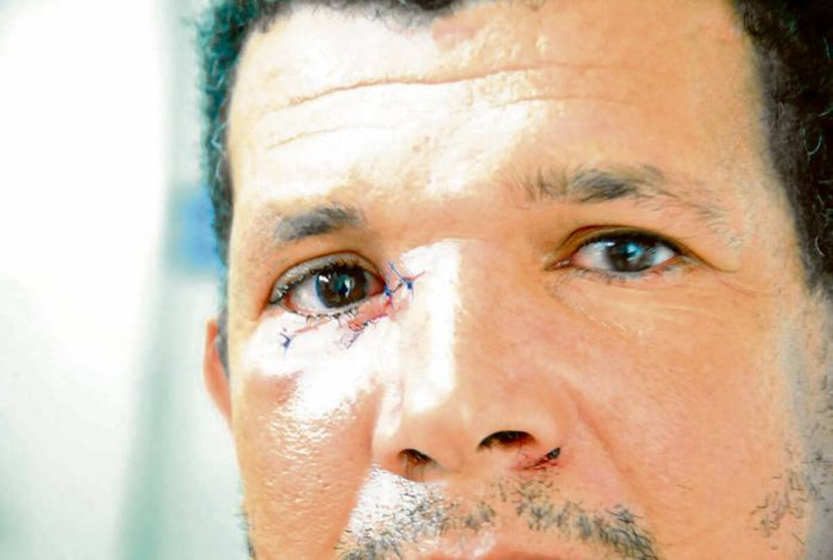 Nilson Argumedo Arrieta, fue herido por un caballo en el municipio de Pueblo Nuevo.