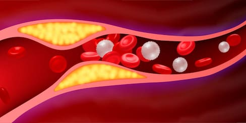 ¿Necesita bajar el colesterol? Esta dieta reduce la obstrucción de arterias