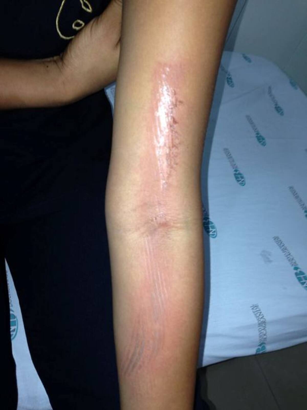 Brazo en el que resultó afectada la joven de 20 años. El Teso