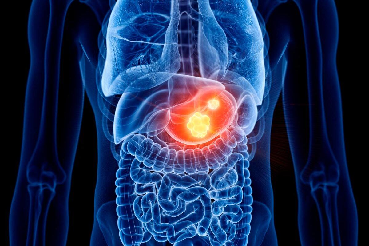 Cáncer gástrico: así puede prevenir esta enfermedad silenciosa y mortal
