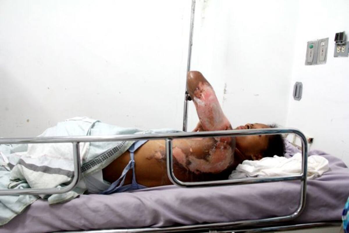 Heidy Pineda tiene quemaduras de tercer grado. Sus parientes dicen que casi no puede conciliar el sueño por el dolor.