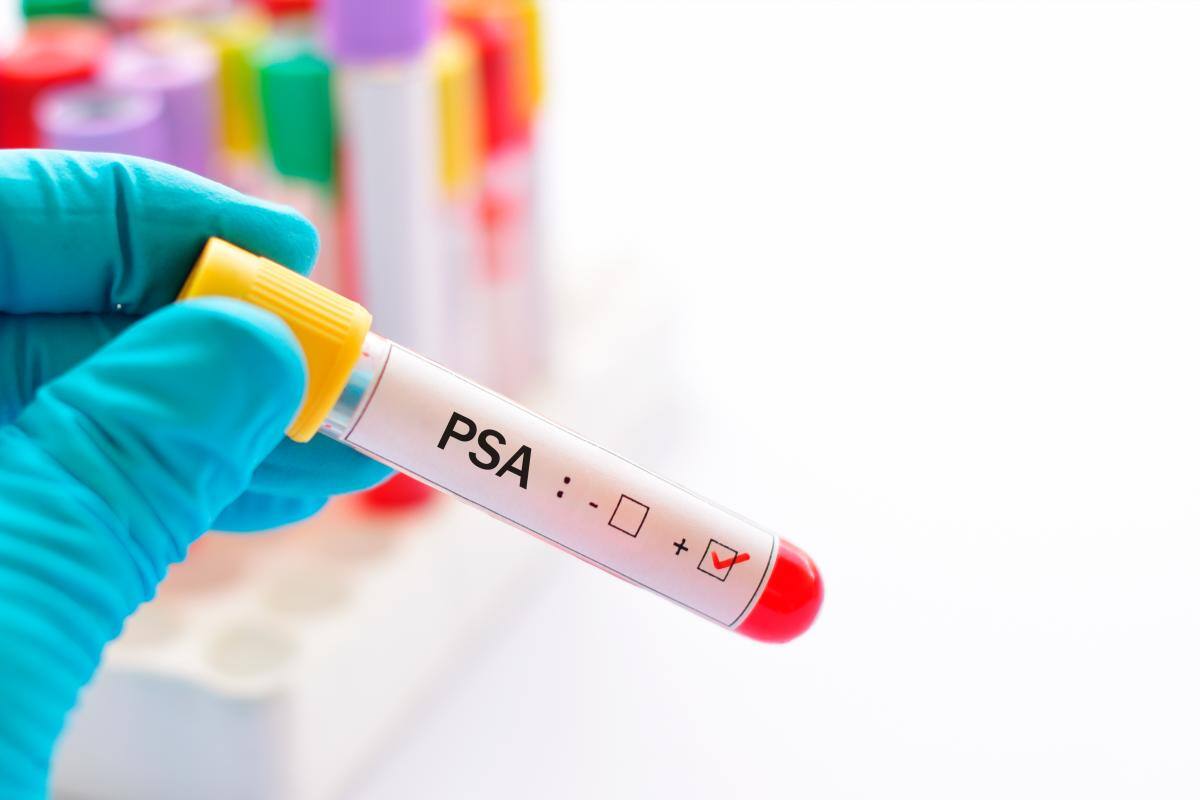 La prueba PSA o Antígeno prostático, es fundamental para la detección de este tipo de cáncer. FOTO RF123