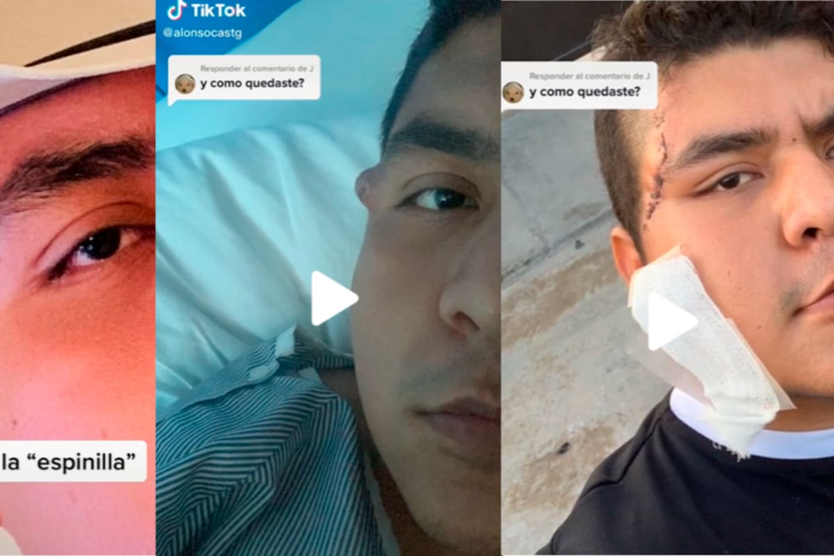 Viral: Lo que pensó que era una espinilla, se convirtió en un tumor