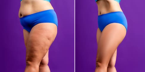 7 alimentos que puedes agregar a tu dieta para eliminar la celulitis