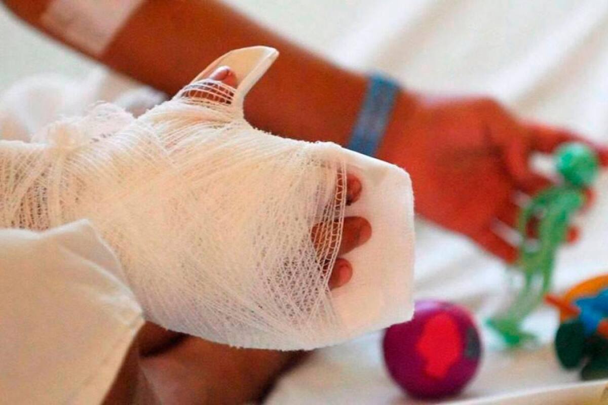 Dos niños y un adulto resultaron quemados en celebración de Fin de Año