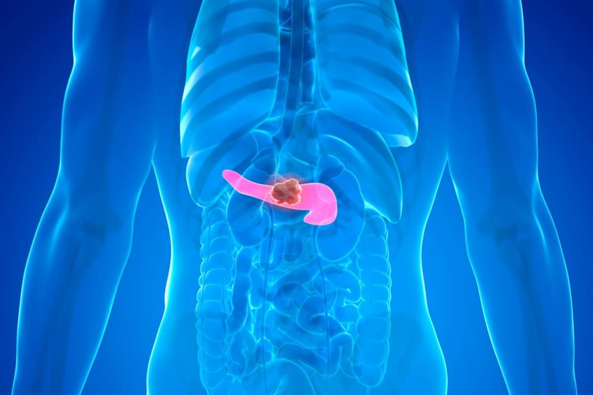Cáncer de páncreas: ¿una vacuna podría evitar su reaparición?