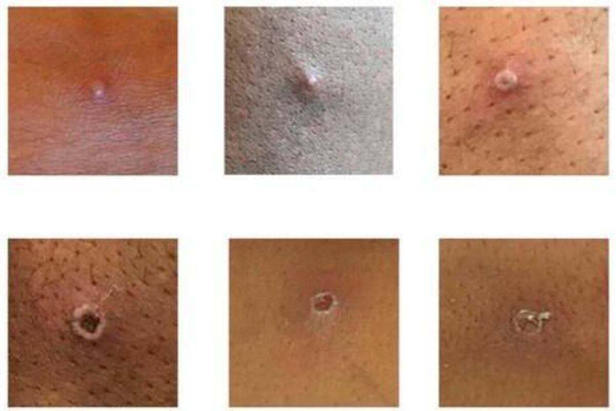 Brote de viruela del mono se redujo por la inmunidad de rebaño: estudio