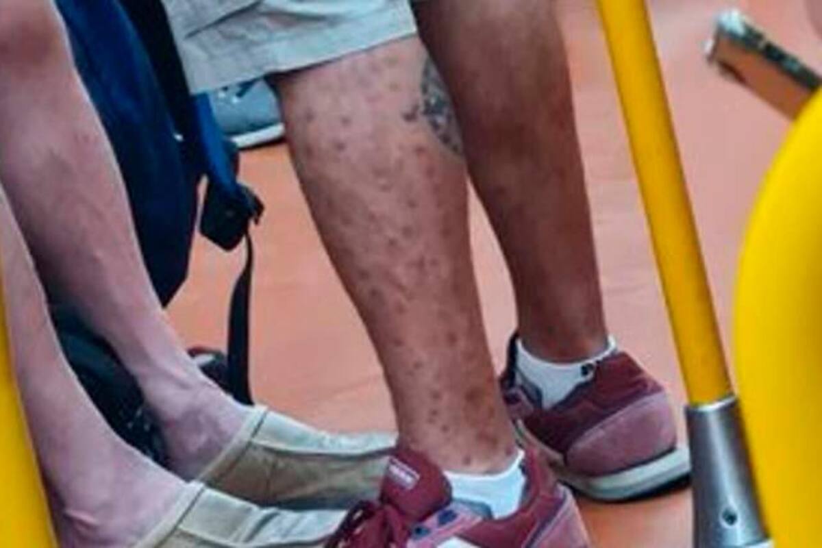 Con granos de viruela del mono, sube a un transporte lleno y discute con médico