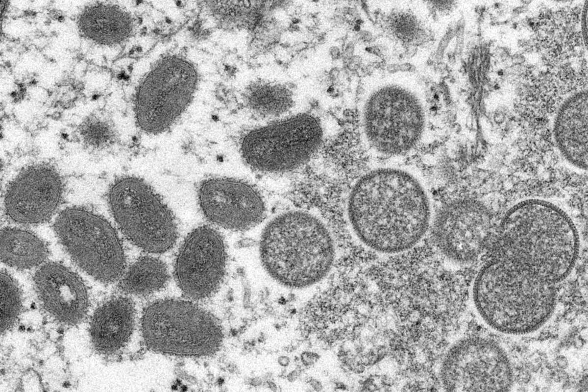 Portugal descubre 5 casos de viruela del mono en hombres