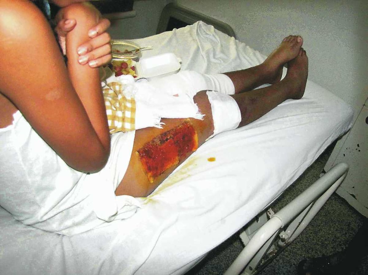 A Heidy le han hecho dos injertos de piel. Aún sigue hospitalizada. EL TESO