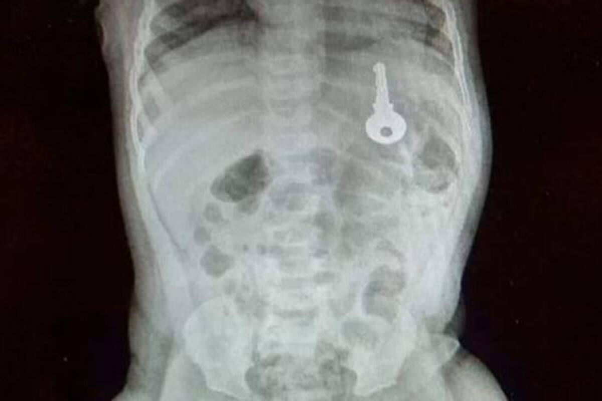 Le extraen llave del estómago a un niño de un año de edad