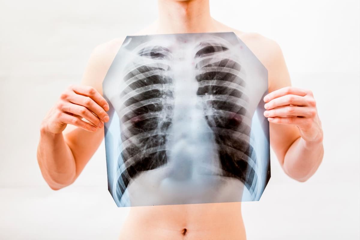 El mundo aún convive con la tuberculosis