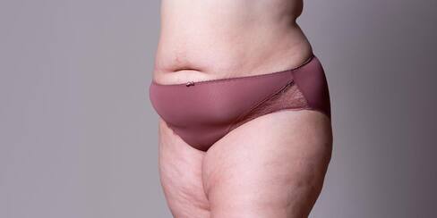 Lipedema, la afección que ataca a las mujeres y se confunde con obesidad