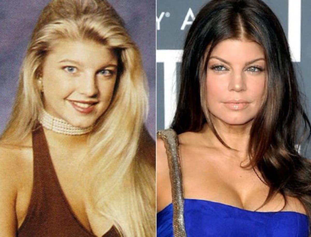 Fergie: Una mujer que poseía una belleza única. Cuando entró al mundo del espectáculo se realizó la rinoplastia, levantamiento de cejas, resaltó más sus pómulos y se inyectó colágeno en sus labios, lo cual perjudicó su cara e hizo que ya no fuera tan bella como antes.