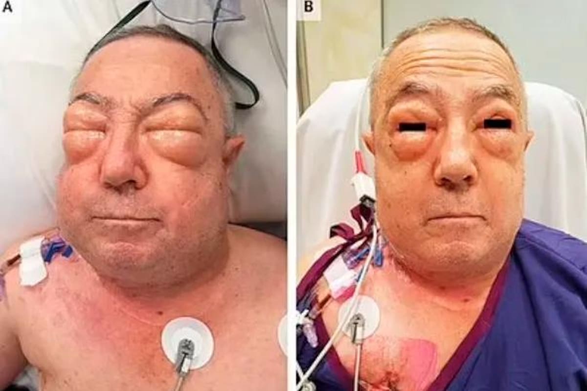 La rara condición por la que un hombre sufrió una terrible hinchazón
