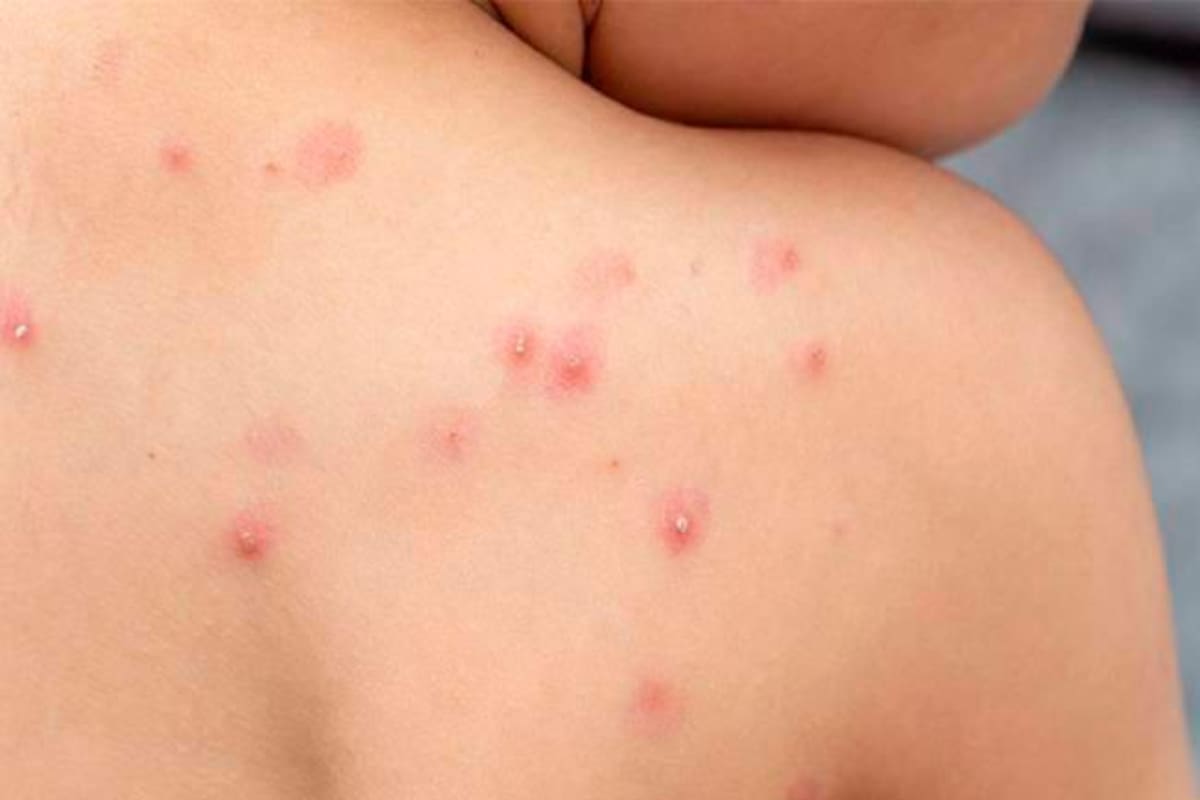 ¡Siguen subiendo! Ya son 582 contagios de viruela del mono en Colombia