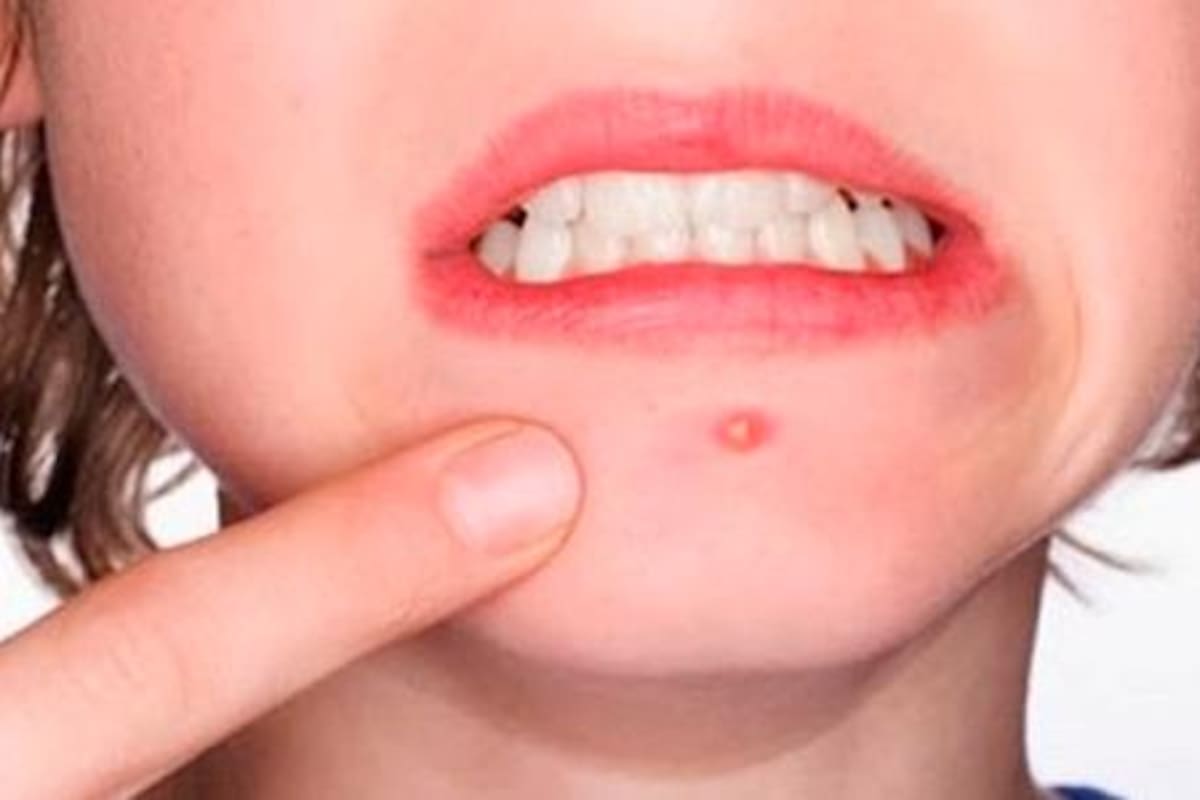 Pubertad precoz, ¿Qué es y cómo manejarla?