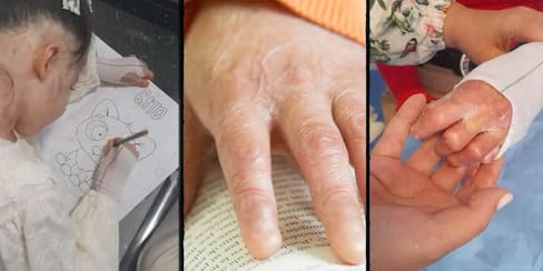 En Barranquilla se reúnen 17 pacientes con piel de mariposa o Epidermólisis Bullosa