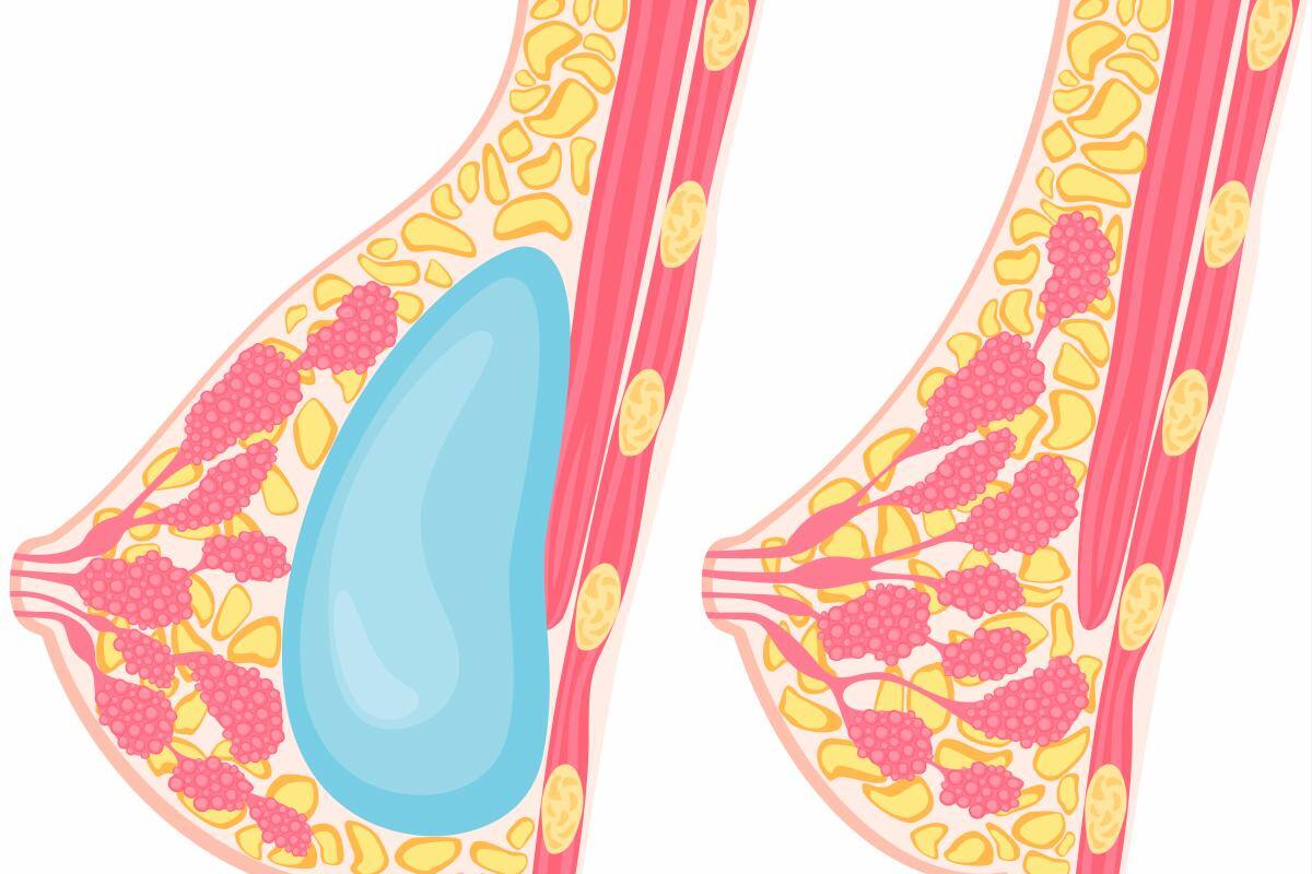 FDA relaciona algunos tipos de cáncer con prótesis tras mamoplastia