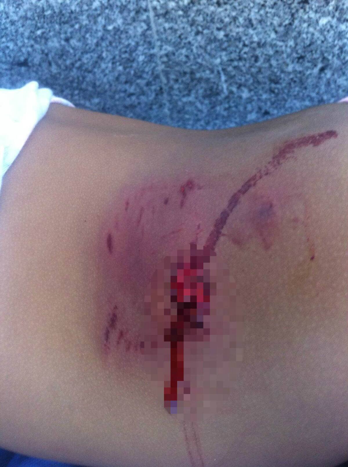 Una de las menores fue mordida en un brazo, mientras que la otra tiene una mordida en el rostro. Foto: Cortesía