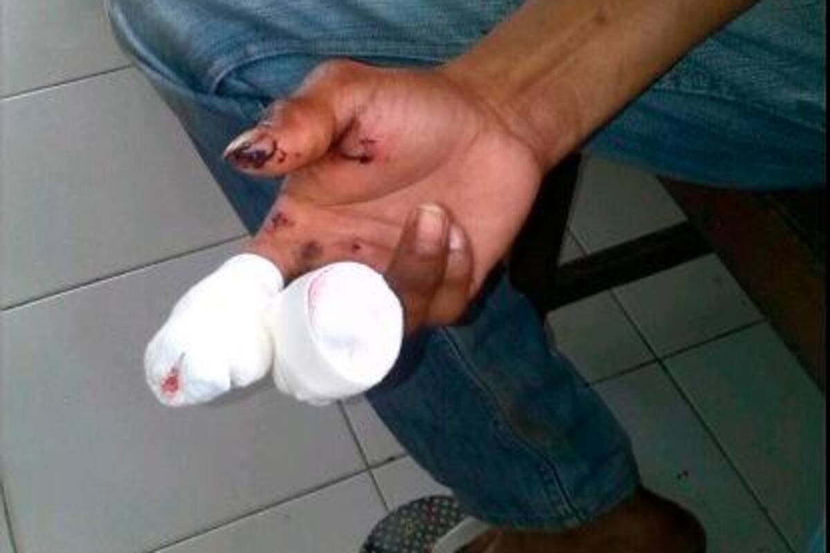 ¡Sí hubo quemados en Cartagena! Estos fueron los casos