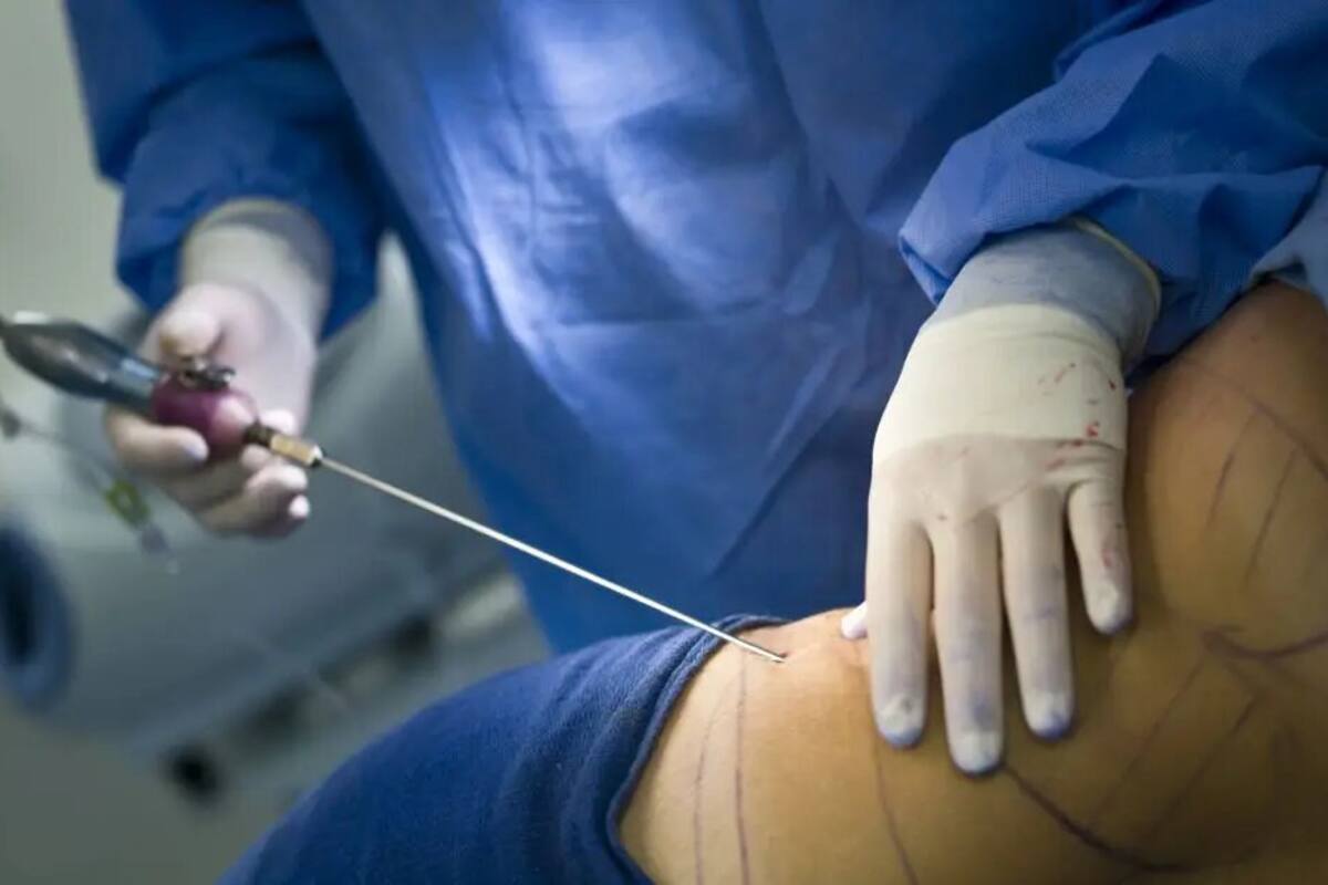 Se hizo una cirugía estética y murió por suero fisiológico defectuoso