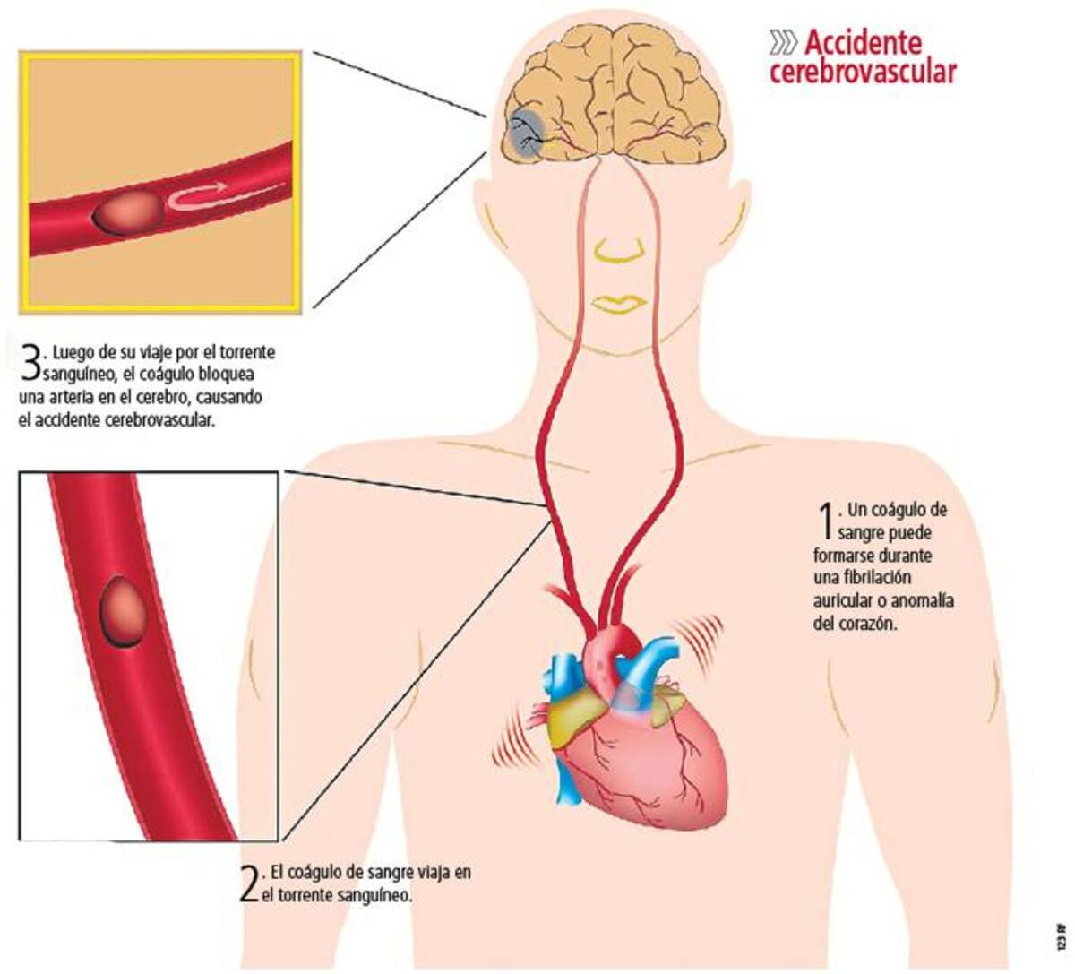 Unos 40 mil colombianos podrían sufrir cada año, una infarto o ataque cerebrovascular. 123 ROYALTY FREE