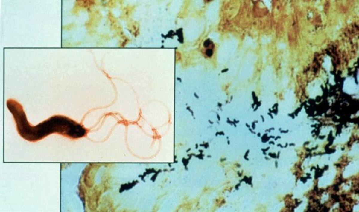Los investigadores pusieron radioisótopos, comúnmente utilizados en la terapia contra el cáncer, a la bacteria. La bacteria radioactiva infectó entonces las células cancerígenas pero no las normales. AP
