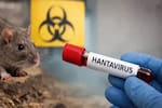 ¿Tiene hantavirus? Los síntomas que debe conocer tras el brote en el crucero