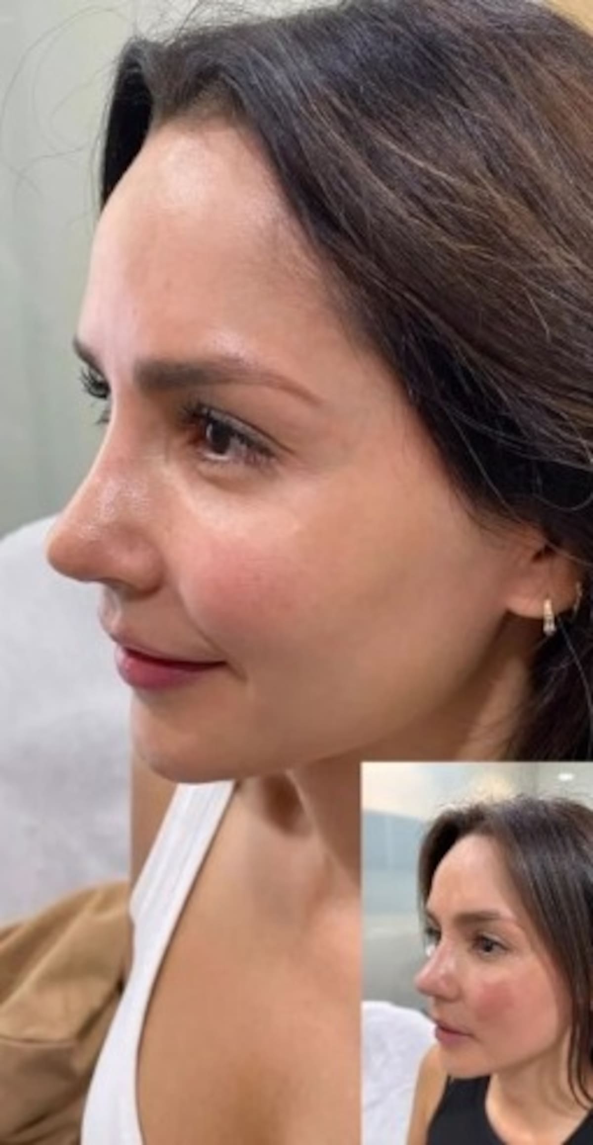 Carmen Villalobos mostró el antes y el después de su piel. //Foto: tomada de internet.