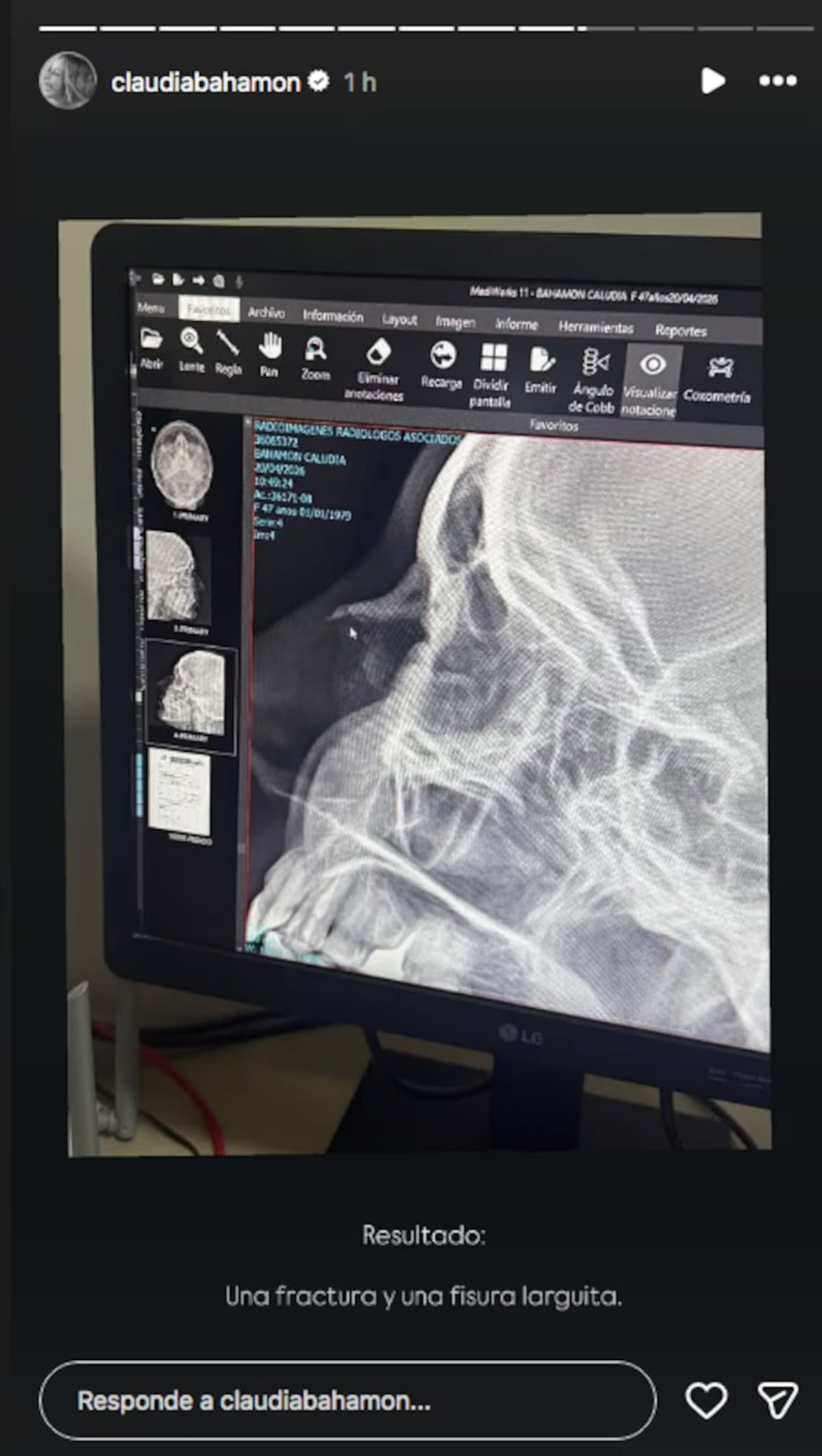 Claudia Bahamón compartió el accidente que tuvo durante sus vacaciones en Santa Marta. //Foto: IG @claudiabahamon.