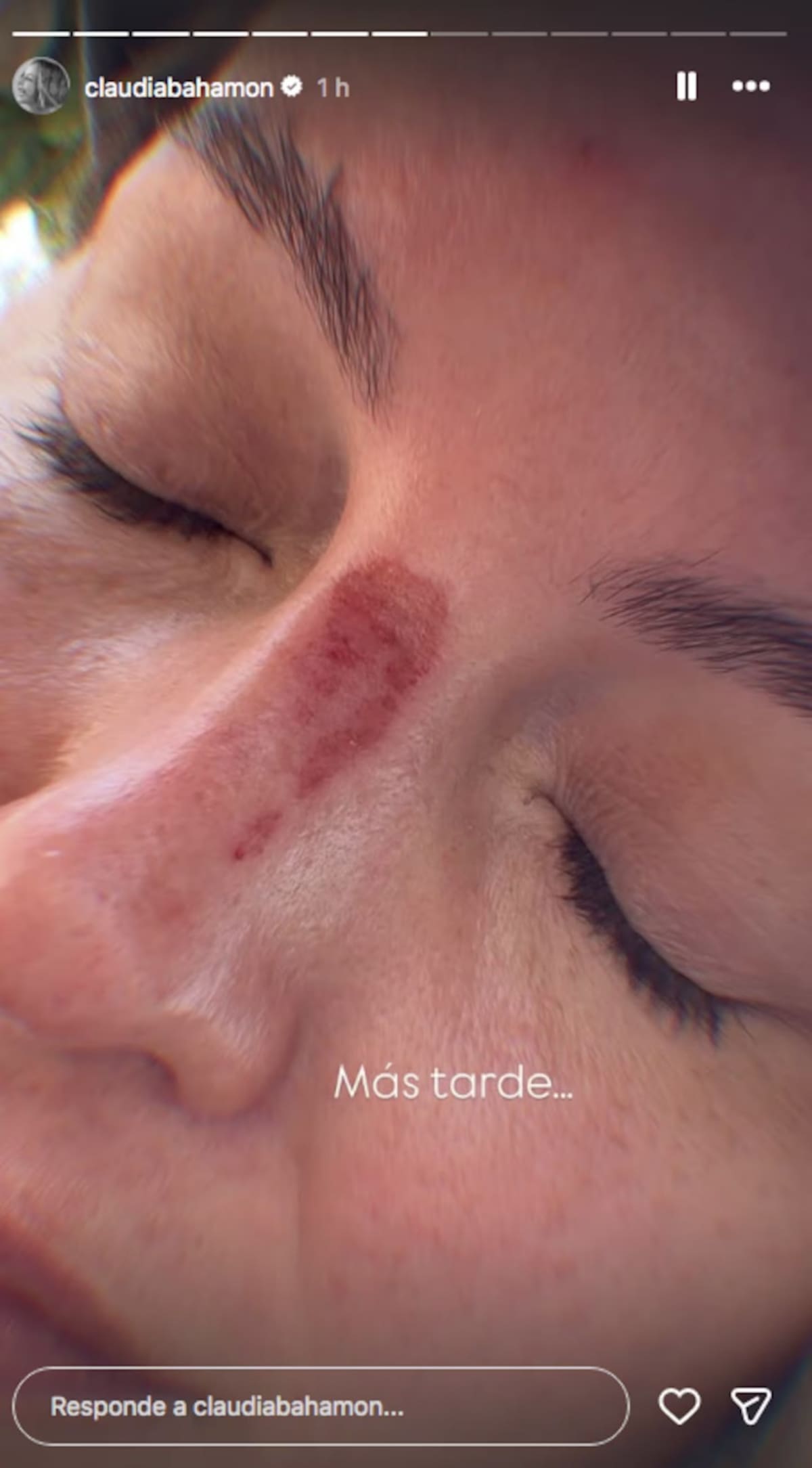 Claudia Bahamón compartió el accidente que tuvo durante sus vacaciones en Santa Marta. //Foto: IG @claudiabahamon.