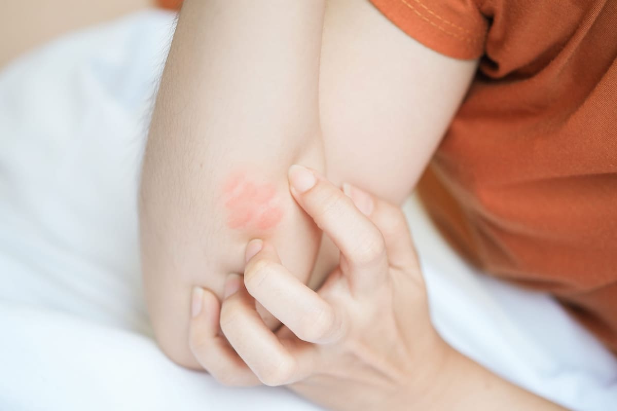El calor, la humedad y el estrés son factores que pueden empeorar la dermatitis atópica. // Foto: 123RF
